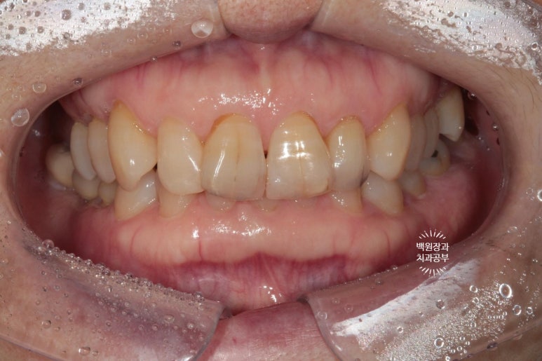삐뚤빼뚤 앞니 세로 금  - 신경치료 없이 지르코니아 크라운으로. 상악동뼈이식술 임플란트. 관련 이미지 2