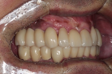 큰 어금니를 잃을 정도의 풍치를 앓으셨다면, 조속한 어금니 임플란트는 필수입니다. 관련 이미지 17