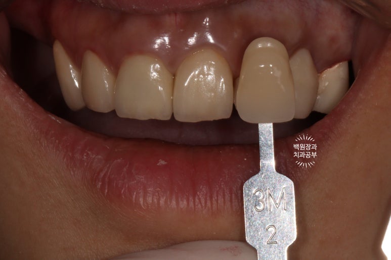 부분틀니 대신 어금니 임플란트를 만들어드립니다. 40대 어금니 상악동 뼈이식 임플란트. 치료기간/비용/과정. 관련 이미지 16