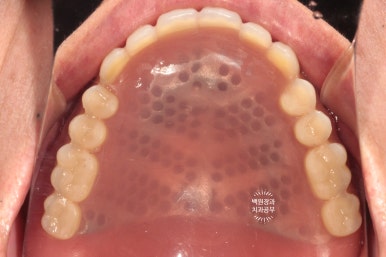 임플란트틀니 - 오버덴쳐. 오스템BA임플란트 이용한 최고의 가성비 치료. 치료과정/치료기간/비용/후기. 관련 이미지 19
