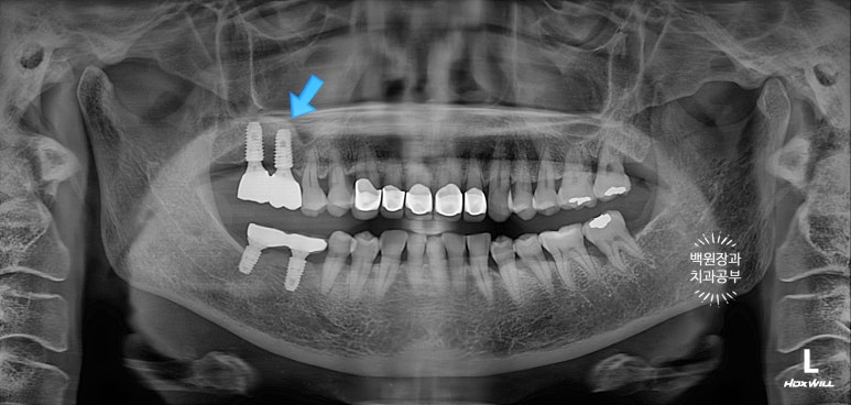 삐뚤빼뚤 앞니 세로 금  - 신경치료 없이 지르코니아 크라운으로. 상악동뼈이식술 임플란트. 관련 이미지 25