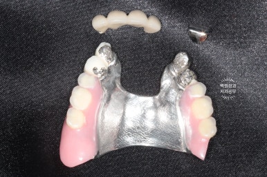 임플란트틀니 - 오버덴쳐. 오스템BA임플란트 이용한 최고의 가성비 치료. 치료과정/치료기간/비용/후기. 관련 이미지 7