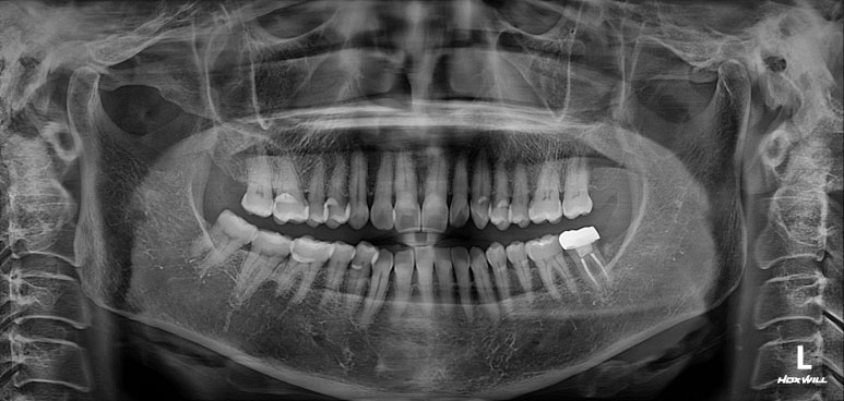 치아크랙 (금간 치아)의 찌릿한 통증 - 발치하지 않고 살려보기. 원인/진단/치료과정/비용/기간. 보존과전문의 치과. 관련 이미지 11