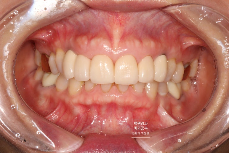 크라운 앞니 충치로 냄새가 나요 - 최소한의 임플란트와 씌우는 치료. 치료과정/기간/비용. 관련 이미지 13
