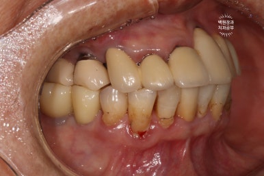스트라우만 임플란트로 이뽑고 바로심는치과 - 믿고 사용하는 세계 1위 스위스 임플란트 회사. 관련 이미지 40