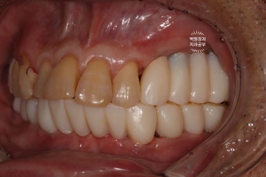 아래 어금니 임플란트 6개면 틀니를 안써도 됩니다.  치주염 전문 착한치과. 치료기간/임시치아과정/후기/비용. 관련 이미지 18