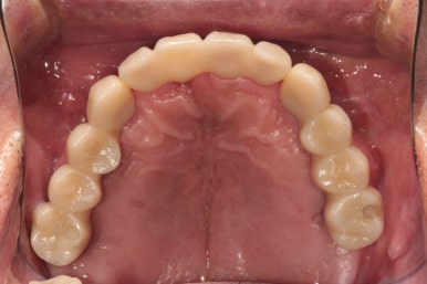 큰 어금니를 잃을 정도의 풍치를 앓으셨다면, 조속한 어금니 임플란트는 필수입니다. 관련 이미지 20