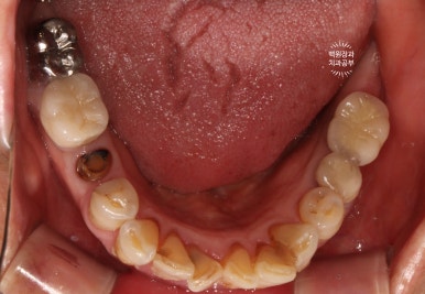 스트라우만 임플란트로 이뽑고 바로심는치과 - 믿고 사용하는 세계 1위 스위스 임플란트 회사. 관련 이미지 8