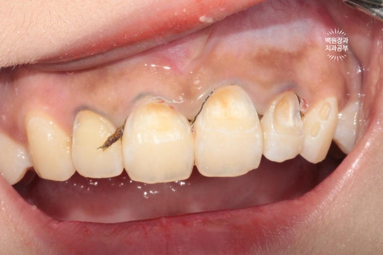 잇몸치료와 앞니 레진치료. 3년이 지난 모습 궁금하지 않으신가요? 3M 레진쓰는 치과. 후기/시간/과정/비용. 관련 이미지 6