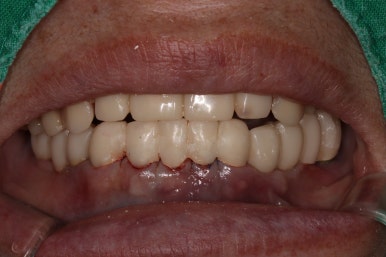 어금니 여러개가 없어요. 전체 임플란트와 앞니 크라운을 통한 완벽한 재건!! 치료과정/치료기간/비용/후기. 관련 이미지 20