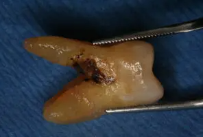 잇몸치료에 대한 모든 것. 치주과 전문의가 설명하는 치주염 치료 비용,과정, 통증, 방법 그리고 치과 실비보험. 관련 이미지 10