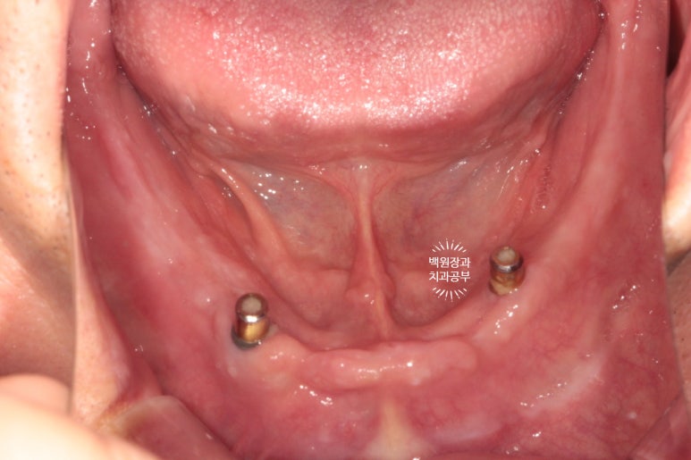 임플란트틀니 - 오버덴쳐. 오스템BA임플란트 이용한 최고의 가성비 치료. 치료과정/치료기간/비용/후기. 관련 이미지 6
