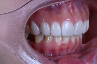 신사역 라미네이트. 결혼식 전 앞니 고민, 얇은 세라믹 레브네이트로 해결! 관련 이미지 18