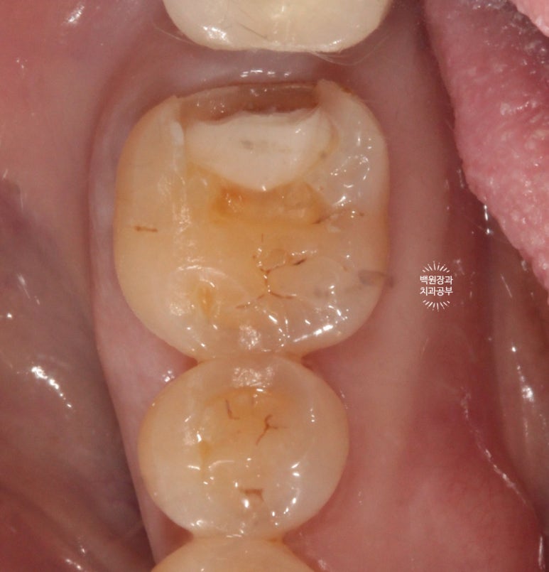 어금니 보철물이 떨어졌어요. 골드인레이 탈락 후 지르코니아 크라운으로 치료. 충치치료과정/치료기간/비용/후기. 관련 이미지 7