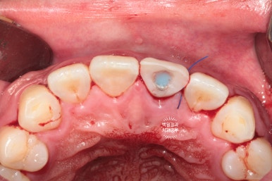 앞니 머리가 기둥째 부러졌어요. 발치 동시 뼈이식 오스템 BA 임플란트. 치료과정/치료기간/비용/후기. 압구정 치과. 관련 이미지 17