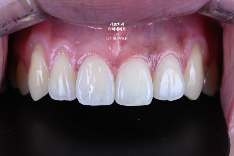 레브네이트 마스터 ; 예비신랑 앞니 무삭제라미네이트. 신사역 치과. 치료후기/비용/가격. 관련 이미지 13