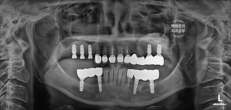 부분틀니 대신 어금니 임플란트를 만들어드립니다. 40대 어금니 상악동 뼈이식 임플란트. 치료기간/비용/과정. 관련 이미지 21