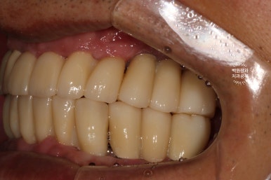 만성치주염으로 인해 아주 좁아진 잇몸뼈에 광범위한 뼈이식 + 전체임플란트. 신사 레브치과. 관련 이미지 55