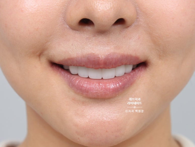 신사역 퍼스널컬러 맞춤 치과. 전담 세라미스트가 앞니 크라운과 라미네이트를 만들어 드립니다. 관련 이미지 16