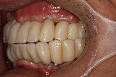 불편한 틀니를 아직도 쓰시나요? 전체 임플란트 치료비용/치료기간/치료과정. 관련 이미지 19