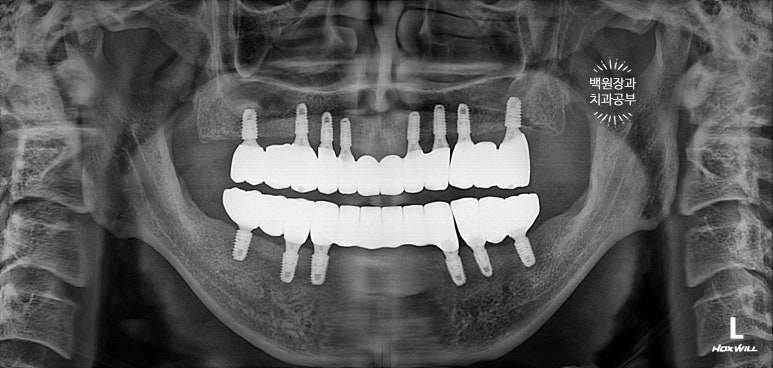 만성치주염으로 인해 아주 좁아진 잇몸뼈에 광범위한 뼈이식 + 전체임플란트. 신사 레브치과. 관련 이미지 59