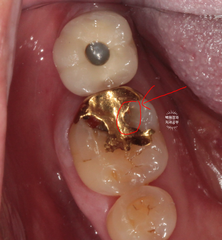 어금니 보철물이 떨어졌어요. 골드인레이 탈락 후 지르코니아 크라운으로 치료. 충치치료과정/치료기간/비용/후기. 관련 이미지 3