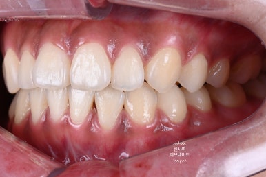 What About Laminates at Sinsa Station? Rev Dental Clinic’s Revnate. image 5