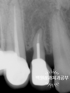 외과적 정출술 (surgical extrusion) - 치아를 살리는 마지막 방법. 치료과정/치료기간/비용/사진. 관련 이미지 13