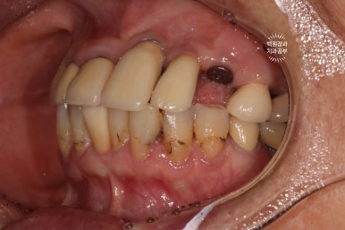 스트라우만 임플란트로 이뽑고 바로심는치과 - 믿고 사용하는 세계 1위 스위스 임플란트 회사. 관련 이미지 21