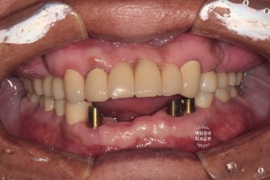 뿌리만 남은 앞니, 어금니가 없어 교합이 무너진 증례. 흡연자의 전체 오스템BA임플란트 재건증례. 치료과정/치료기간/비용/후기. 관련 이미지 23