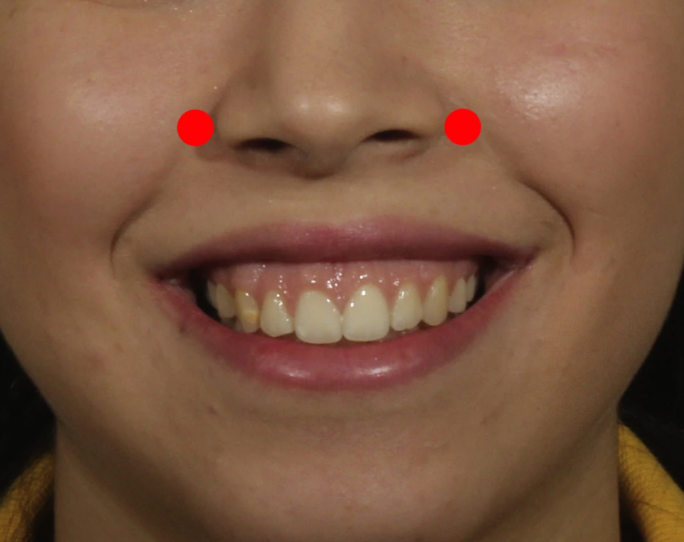 이갈이 보톡스, 신사역 치과 의사가 설명히는 효과, 주기, 통증,가격 총정리 관련 이미지 6