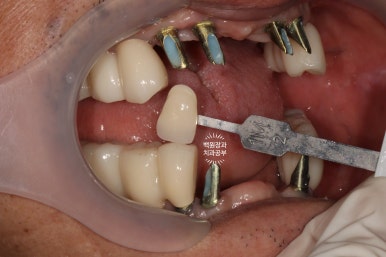 불편한 틀니를 아직도 쓰시나요? 전체 임플란트 치료비용/치료기간/치료과정. 관련 이미지 22