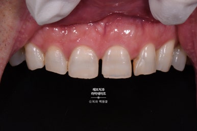 신사역 무삭제 라미네이트 : 레브네이트 내츄럴 최소삭제 비니어. 50대 앞니 벌어짐 비용/후기/얼굴사진. 관련 이미지 15