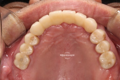 오스템임플란트 네비게이션 전체 임플란트 치료일기. 치료과정/치료기간/비용/솔직후기. 관련 이미지 35