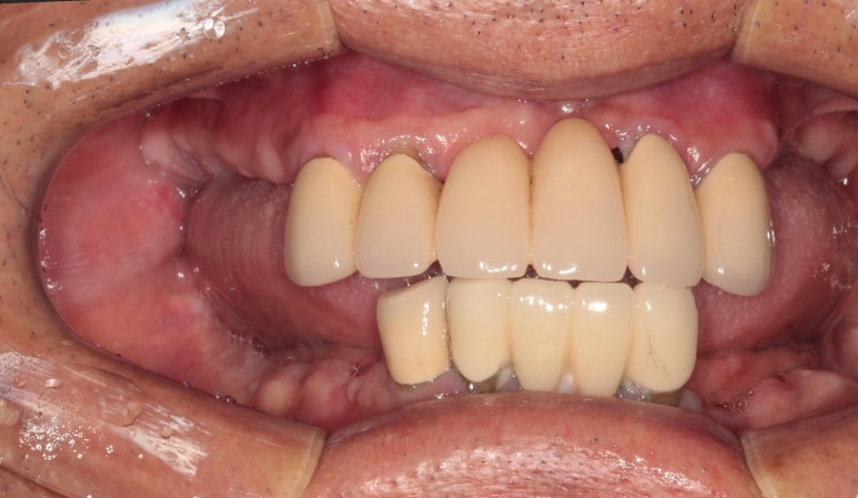 잇몸 염증 고름이 심했던 부위 - 만성치주염 진단하고 임플란트로 깔끔하게 치료! 신사역 치과 관련 이미지 9