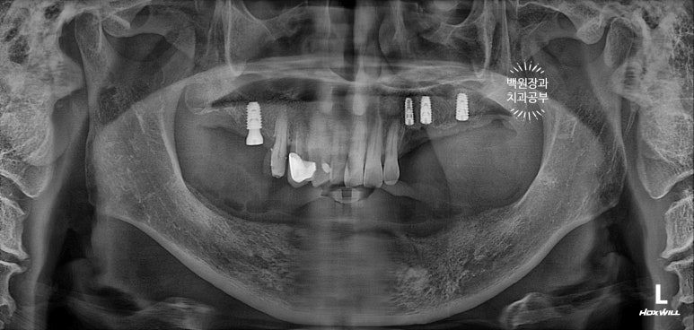 아래 어금니 임플란트 6개면 틀니를 안써도 됩니다.  치주염 전문 착한치과. 치료기간/임시치아과정/후기/비용. 관련 이미지 12