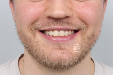 A European Patient at [Rev Dental Clinic] near Sinsa Station in Seoul Wanted Front Tooth Decay Treated with an EMAX All-Ceramic Crown. image 6