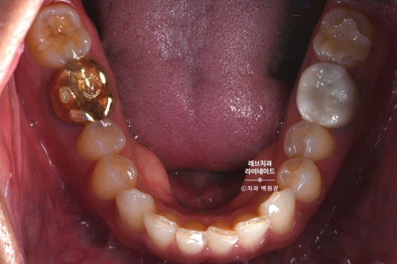 아래앞니 라미네이트도 무삭제로 가능한가요? 레브네이트 베이직 가격/비용/후기/추천. 관련 이미지 4