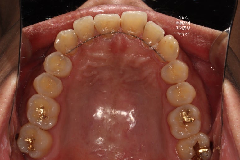교정 유지장치 근처 앞니 옆면 충치 및 착색 간단히 3M 레진으로 치료. 치료과정/비용/후기. 과잉진료 없는 치과. 관련 이미지 8
