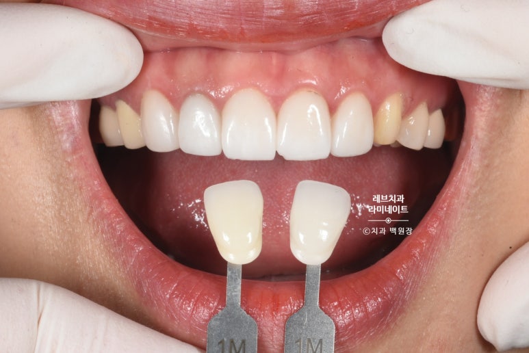 신사역 퍼스널컬러 맞춤 치과. 전담 세라미스트가 앞니 크라운과 라미네이트를 만들어 드립니다. 관련 이미지 6