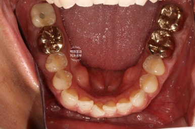 신경치료한 치아 부러짐! 뼈이식 하면서 임플란트 수술하는 과정/기간/비용. 관련 이미지 18