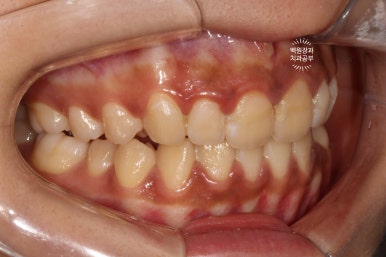 잇몸치료와 앞니 레진치료. 3년이 지난 모습 궁금하지 않으신가요? 3M 레진쓰는 치과. 후기/시간/과정/비용. 관련 이미지 10