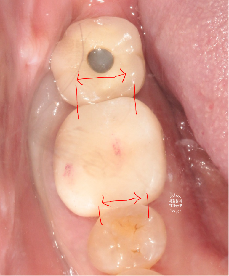 어금니 보철물이 떨어졌어요. 골드인레이 탈락 후 지르코니아 크라운으로 치료. 충치치료과정/치료기간/비용/후기. 관련 이미지 13