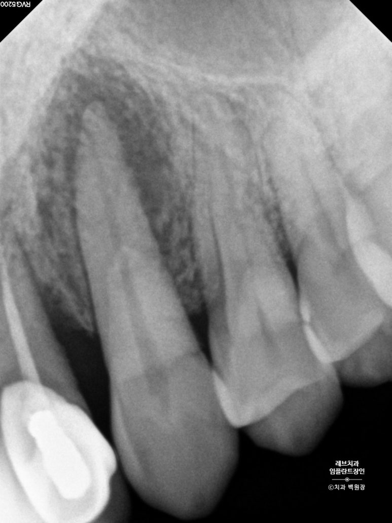 앞니 부러짐? 뽑고 바로 임플란트 + 뼈이식. 앞니 흔들림? 뽑고 1달 기다리고 임플란트 + 뼈이식. 신사역 치과 후기/비용/과정. 관련 이미지 14