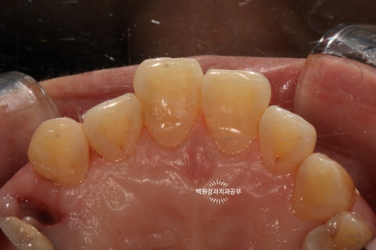 앞니레진치료 할 줄 모르는 치과의사는 없지만, 좋은 레진으로 치료하는 치과의사는 잘 없습니다. 관련 이미지 27