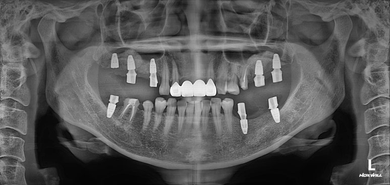 전세계 1위 스트라우만 임플란트를 사용한 어금니 기능회복과 앞니 지르코니아 크라운 증례. 관련 이미지 17