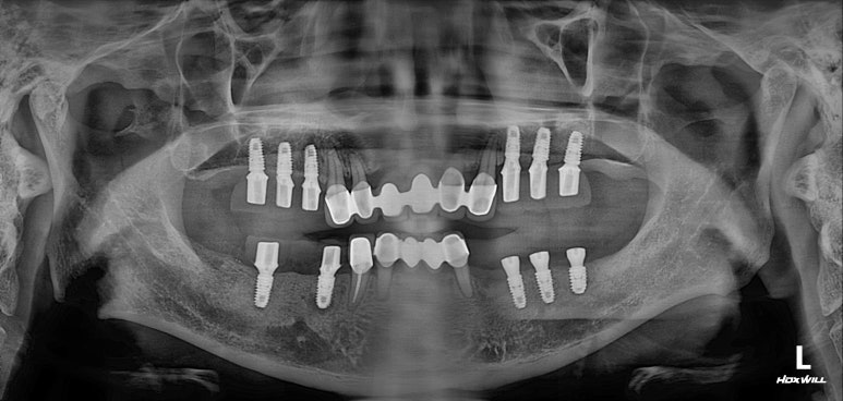 잇몸 염증 고름이 심했던 부위 - 만성치주염 진단하고 임플란트로 깔끔하게 치료! 신사역 치과 관련 이미지 23