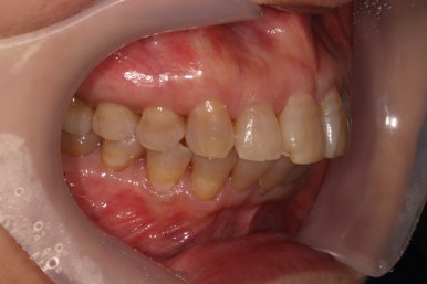 삐뚤어진 앞니를 8개월만에 가지런하게 만드는 50대 성인부분교정. 신사역 교정치과. 치료과정/기간/비용. 관련 이미지 26
