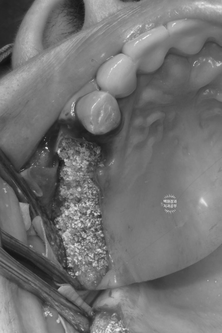 60대 임플란트 주변에서 고름이 나와요. 실패한 임플란트 제거 후 재수술. 덴티움 뼈이식재를 사용한 치조골 이식술. 관련 이미지 6
