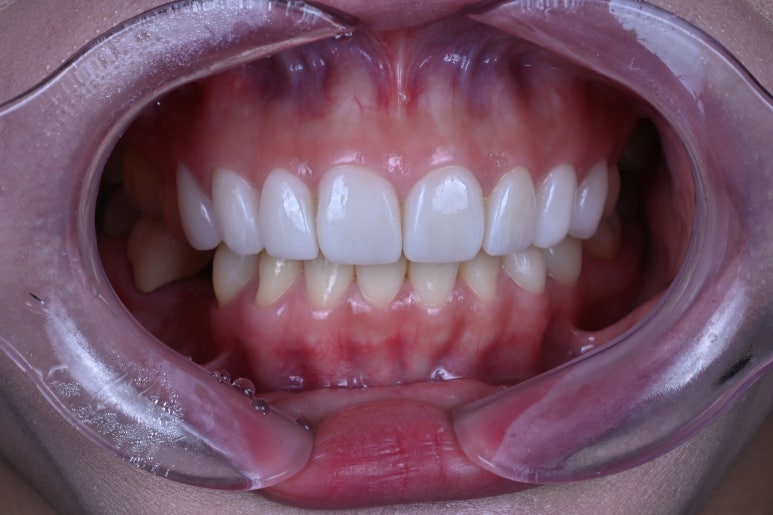 신사역 라미네이트. 결혼식 전 앞니 고민, 얇은 세라믹 레브네이트로 해결! 관련 이미지 17